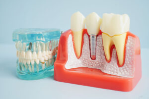 Dental implant, artificial tooth roots into jaw, root canal of dental treatment, gum disease, teeth model for dentist studying about dentistry.