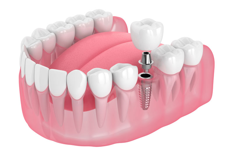 single-dental-implant