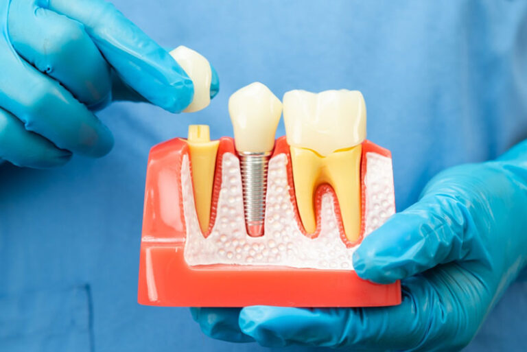 Dentist wearing blue gloves holding a dental implant model, demonstrating the components of a tooth implant including crown, abutment, and titanium post for patient education.