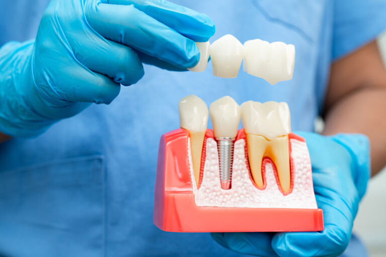 Dentist demonstrates dental implants and crown models in a clinical setting during consultation.